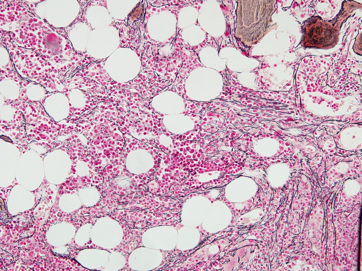 Reticulin showing +2-+3 fibrosis on 1-4 scale
